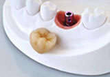 implant
