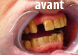 Valplast