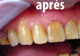 Valplast