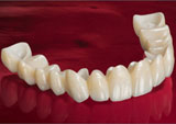 ceramo-metal